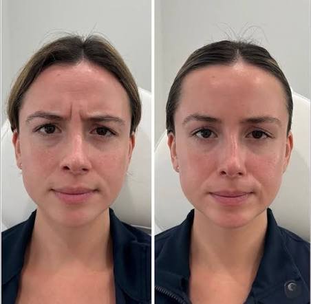 Baby Botox Australia